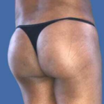 Brazilian Butt Lift Before & After Patient #8809