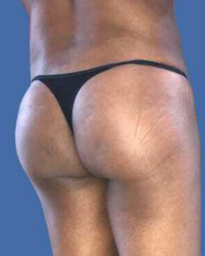 Brazilian Butt Lift Before & After Patient #8809