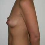 Breast Augmentation Before & After Patient #8838