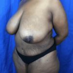 Breast Lift / Mannequin Breast Lift Before & After Patient #8959