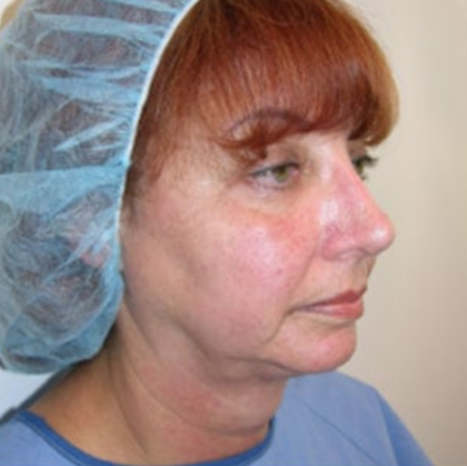 Facelift and Necklift Before & After Patient #9017