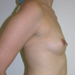 Breast Augmentation Before & After Patient #8845