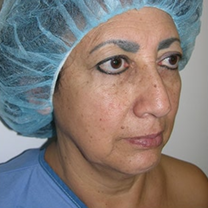 Facelift and Necklift Before & After Patient #7811
