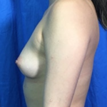 Breast Augmentation Before & After Patient #8866