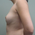 Breast Augmentation Before & After Patient #8895