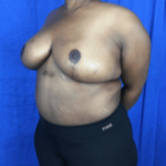 Breast Lift / Mannequin Breast Lift Before & After Patient #8959