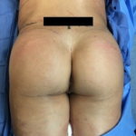 Brazilian Butt Lift Before & After Patient #8802