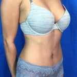 Liposuction Before & After Patient #7965