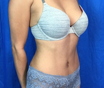 Liposuction Before & After Patient #7965