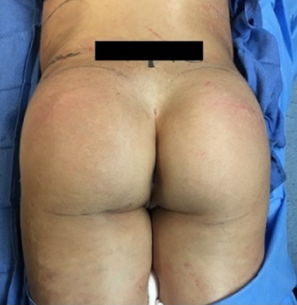 Brazilian Butt Lift Before & After Patient #8802