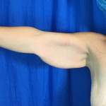 Arm Lift Before & After Patient #7196