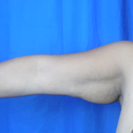 Arm Lift Before & After Patient #7209