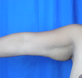 Arm Lift Before & After Patient #7209