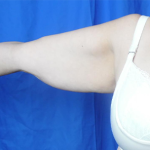 Arm Lift Before & After Patient #7214