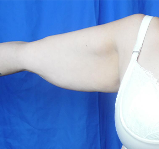 Arm Lift Before & After Patient #7214