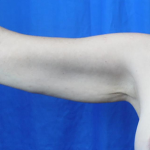 Arm Lift Before & After Patient #7217