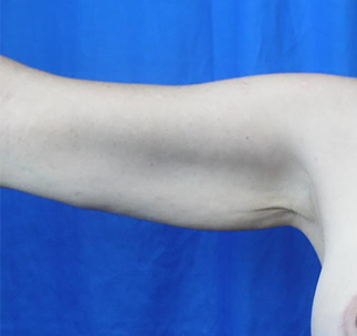 Arm Lift Before & After Patient #7217