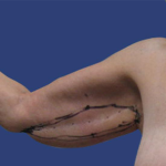 Arm Lift Before & After Patient #7222