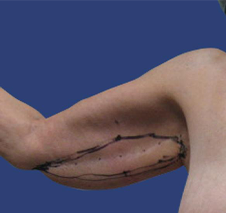Arm Lift Before & After Patient #7222