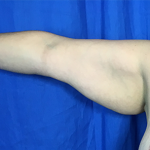 Arm Lift Before & After Patient #7225