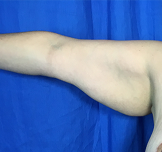 Arm Lift Before & After Patient #7225