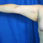 Arm Lift Before & After Patient #7191