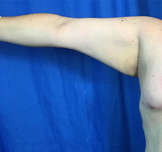 Arm Lift Before & After Patient #7191
