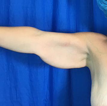 Arm Lift Before & After Patient #7196