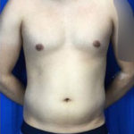 Liposuction Before & After Patient #7945