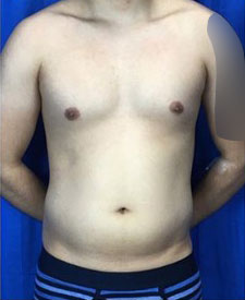 Liposuction Before & After Patient #7945