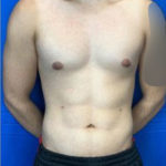 Liposuction Before & After Patient #7945