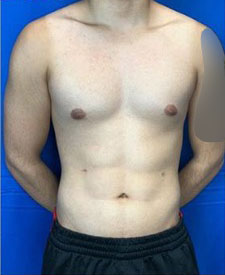 Liposuction Before & After Patient #7945