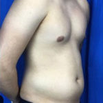 Liposuction Before & After Patient #7945