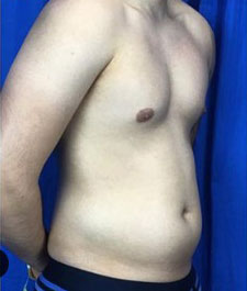 Liposuction Before & After Patient #7945