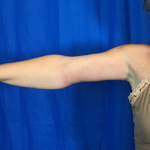 Arm Lift Before & After Patient #7196