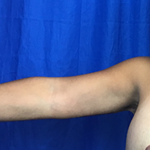 Arm Lift Before & After Patient #7209
