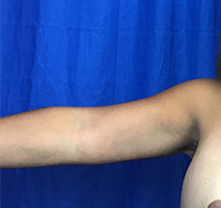 Arm Lift Before & After Patient #7209