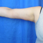 Arm Lift Before & After Patient #7214