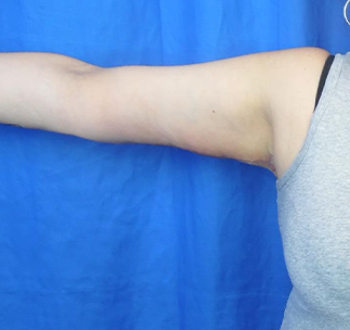 Arm Lift Before & After Patient #7214