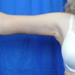 Arm Lift Before & After Patient #7217