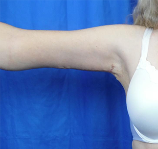 Arm Lift Before & After Patient #7217
