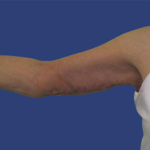 Arm Lift Before & After Patient #7222