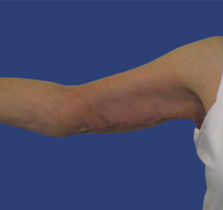 Arm Lift Before & After Patient #7222