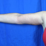 Arm Lift Before & After Patient #7225