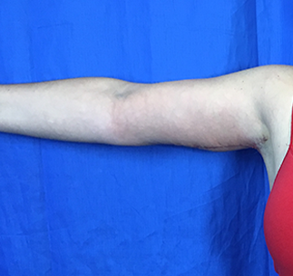 Arm Lift Before & After Patient #7225