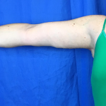 Arm Lift Before & After Patient #7191