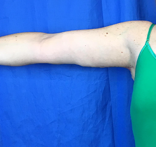 Arm Lift Before & After Patient #7191