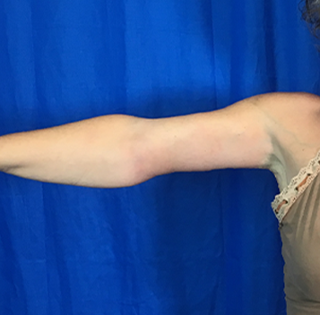 Arm Lift Before & After Patient #7196