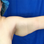 Arm Lift Before & After Patient #7206