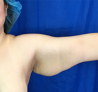 Arm Lift Before & After Patient #7206